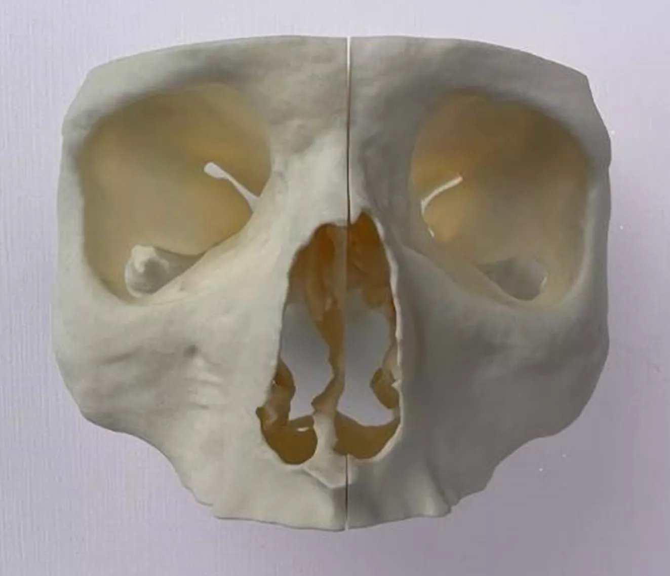 Printed iteration of a maxillofacial model